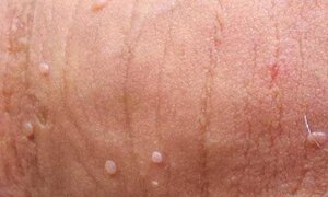 Bệnh sùi mào gà và những điều phụ huynh ít biết