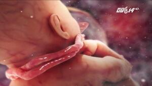 Kỳ lạ em bé ở TP.HCM chào đời với 4 vòng dây rốn quấn cổ