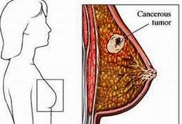 Cách nhận biết ung thư vú đơn giản nhất ai cũng nên biết