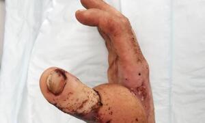 Cận cảnh bác sĩ bệnh viện Xanh Pôn chuyển đốt ngón chân thành... ngón tay