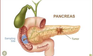 Ung thư tuyến tụy: Phẫu thuật sớm tăng tỉ lệ thành công cao
