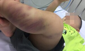 Chưa tìm ra địa chỉ bé trai bị tím bầm chân nghi do bạo hành