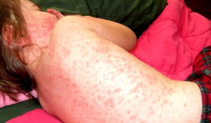 Phát hiện trẻ sốt xuất huyết, cần làm ngay những việc gì?