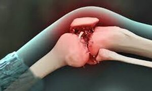 Những điều nên biết về bệnh ung thư xương