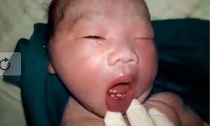 Kỳ lạ: Em bé vừa chào đời đã mọc răng cửa