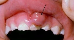 Dấu hiệu ung thư khoang miệng dễ bị bỏ qua