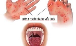 Sắp khai giảng, Bộ Y tế khuyến cáo nguy cơ dịch tay chân miệng bùng phát
