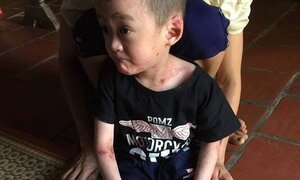 Mắc bệnh hiếm gặp không thể chữa khỏi, bé 5 tuổi ở Phú Thọ cầu cứu trong tuyệt vọng
