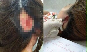 Bỏng da đầu, sốc phản vệ đi cấp cứu sau khi nhuộm tóc