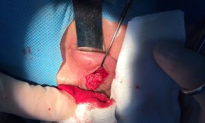 Phát hiện giun ký sinh trong u hốc mắt của bệnh nhân