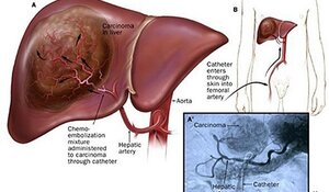Bệnh nhân u gan sẽ mừng rơi nước mắt nếu được áp dụng kỹ thuật này