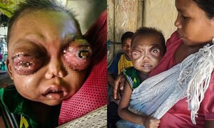 Hình ảnh đau lòng của em bé 2 tuổi bị viêm hốc mắt vô căn