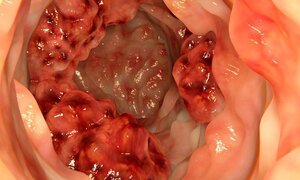 10 thực phẩm giảm nguy cơ ung thư đại trực tràng