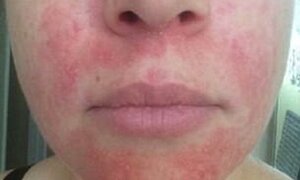 Tác dụng bất ngờ của 'thần dược' mật ong