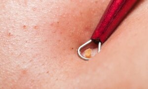 Những 'dị vật' bất ngờ có trong nốt mụn trên mặt bạn