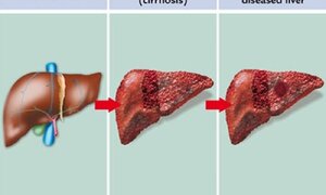 Chữa ung thư gan thế nào để kéo dài sự sống thêm nhiều năm?