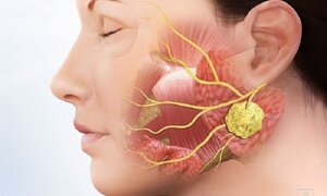 Mùa đông cẩn trọng kẻo mắc quai bị