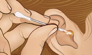 Để ý màu sắc của ráy tai, có thể biết được mắc bệnh gì