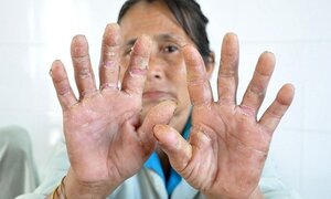 Quảng Ngãi: Nhiều người tái mắc 'bệnh lạ' cực kỳ nguy hiểm