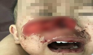Xót xa bé trai 1 tuổi bị chó nhà cắn rách mặt, mất mũi
