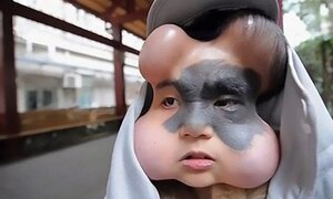 Căn bệnh lạ khiến cô gái 9X có 4 trái bóng trên khuôn mặt