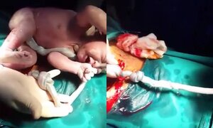 Video: Cận cảnh em bé bị dây rau thắt nút chào đời khỏe mạnh