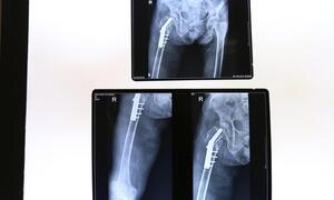 Ngã trong lúc đi vệ sinh, cụ bà 105 tuổi bị gãy mấu chuyển xương đùi phải