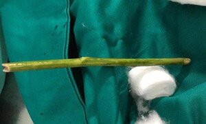 Chọc que nứa phá thai và những trường hợp phá thai kinh dị ở Việt Nam