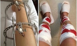 Ca phẫu thuật kéo dài chân kỷ lục ở Việt Nam
