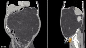 Mang khối u khổng lồ bao năm cứ ngỡ là bụng bia