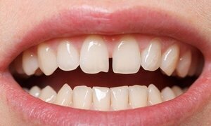 Hai chiếc răng cửa tiết lộ bí ẩn ít người biết về bạn
