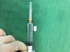 Mảnh cùi dừa găm vào thanh quản bệnh nhi suýt chết