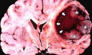 Nội soi lấy khối u não qua đường mũi cho bệnh nhân ở Phú Thọ