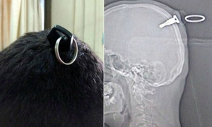 Ba giờ mổ rút chiếc chìa khóa xe máy cắm trong sọ chàng trai