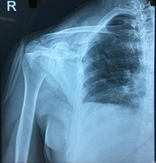 Dao đâm thấu ngực, nữ bệnh nhân có nhóm máu cực hiếm suýt chết