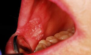 Đây là những dấu hiệu cảnh báo ung thư mà bạn nên nhớ