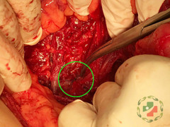 Mắc bệnh hoang tưởng, chồng dùng mũi tên xiên cá đâm vợ