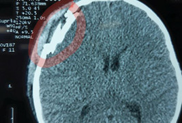 Bị đập chai bia vào đầu, bé trai chấn thương sọ não