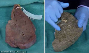 Kinh hoàng cận cảnh lá gan đốm đen, xám xịt của người nghiện rượu