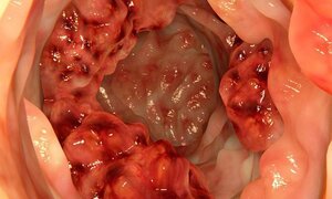 7 dấu hiệu ung thư đại trực tràng rất nhiều người chủ quan bỏ qua