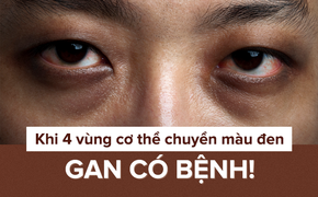 Khi 4 bộ phận cơ thể chuyển màu đen: Hãy thận trọng dấu hiệu bệnh gan đang phát triển