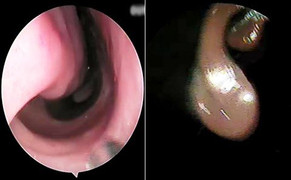 Kinh hãi con vắt dài 7cm sống ký sinh trong mũi cụ bà suốt gần 1 tháng