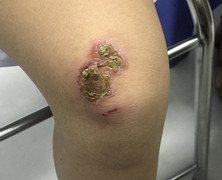 Cảnh giác con bạn dễ nhiễm trùng da, lở loét hơn trong mùa hè