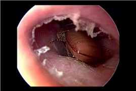 Video: Rùng mình cảnh gắp con gián chết thối rữa ra khỏi lỗ tai người phụ nữ