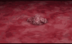 Clip cho thấy ung thư di căn phát triển như thế nào và phá hủy cơ thể người bệnh ra sao