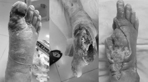 Tự mua thuốc trị đái tháo đường, trả giá bằng bàn chân phải hoại tử