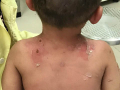 Lại tin lá rừng, bé trai 2 tuổi nổi mụn lở loét, trợt da khắp người