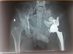 Bị khối u khổng lồ chiếm khớp háng, đâm vào ổ bụng, chàng trai phải chống nạng đến bệnh viện điều trị