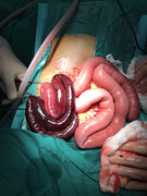 2 ngày không đi đại tiện, cụ ông bị hoại tử 1 m ruột