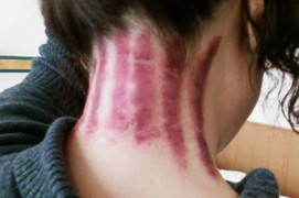 Thực hư tác dụng khi dùng đồng bạc cạo gió